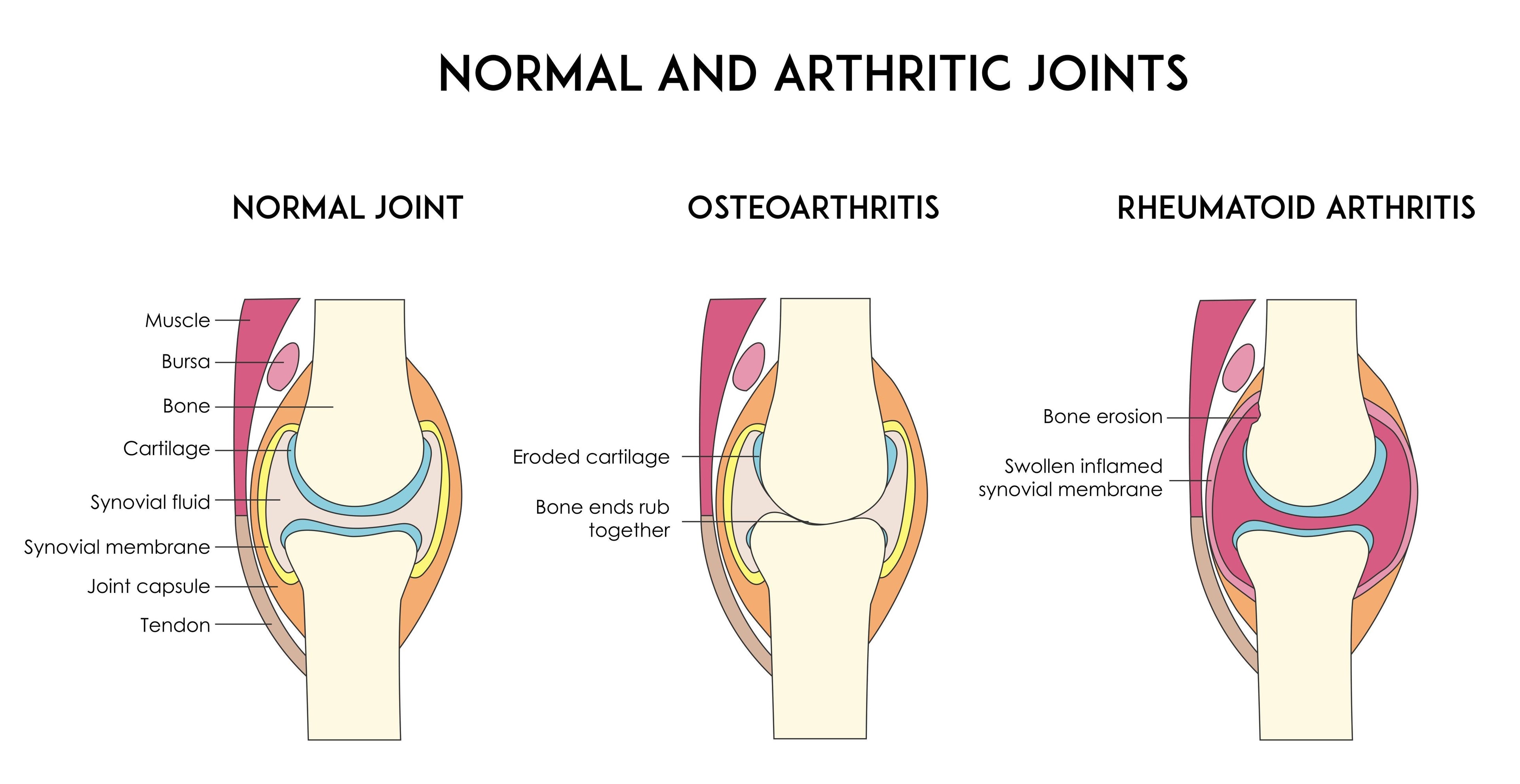 Fight Arthritis with Gameday CBD